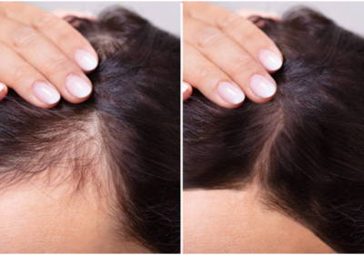 What is the best way to stop/control hair loss in women